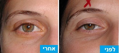 לפני ואחרי ניתוח הרמת עפעפיים