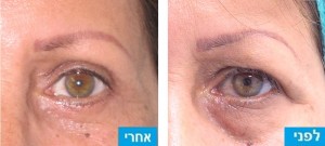 לפני ואחרי ניתוח מתיחת עפעפיים עליונים