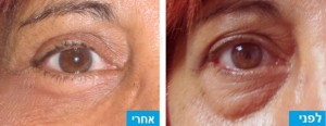 לפני ואחרי הסרת עודפי שומן ועור מהעפעפיים