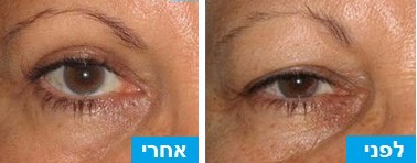לפני ואחרי ניתוח עפעפיים לחיזור השריר והסרת עודפי עור ושומן