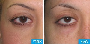 עיגולים שחורים מסביב לעיניים