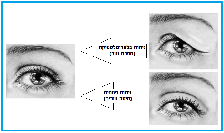 סוגי ניתוחי עפעפיים עליונים